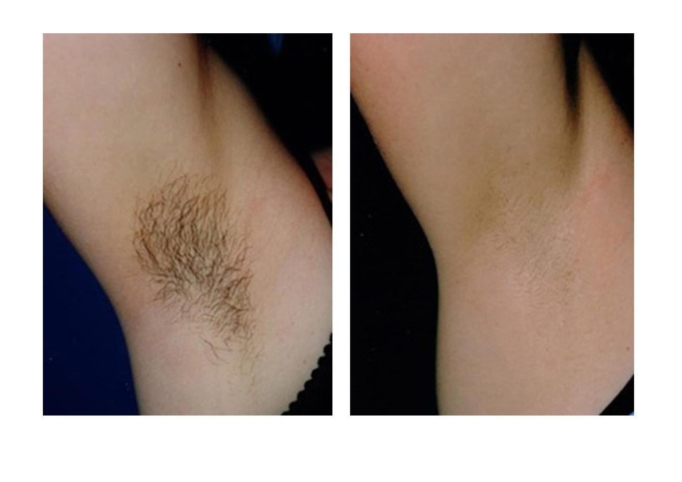 удаление волос с груди у женщин фото 73
