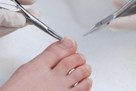 Combiped: лечение вросшего ногтя без операций