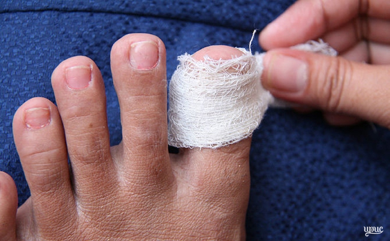 Как лечить нарыв под ногтем на руке или ноге?