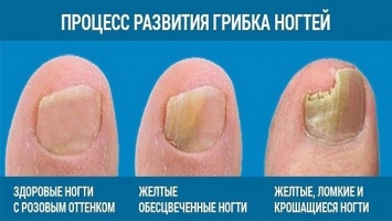 Лечение при вросшем ногте на ноге