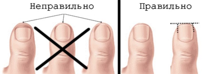 Диагностика неприрастающего ногтя